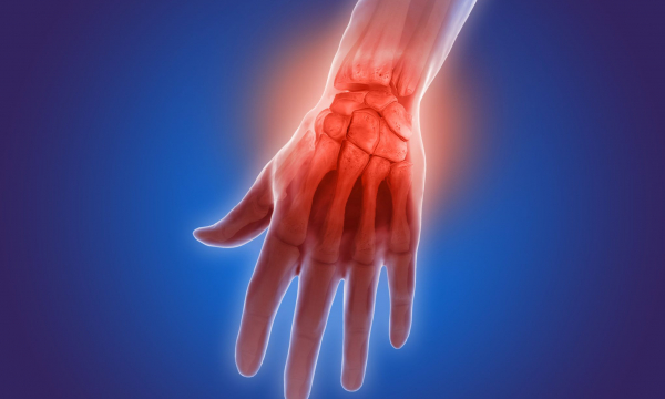 tratamiento para la artritis 